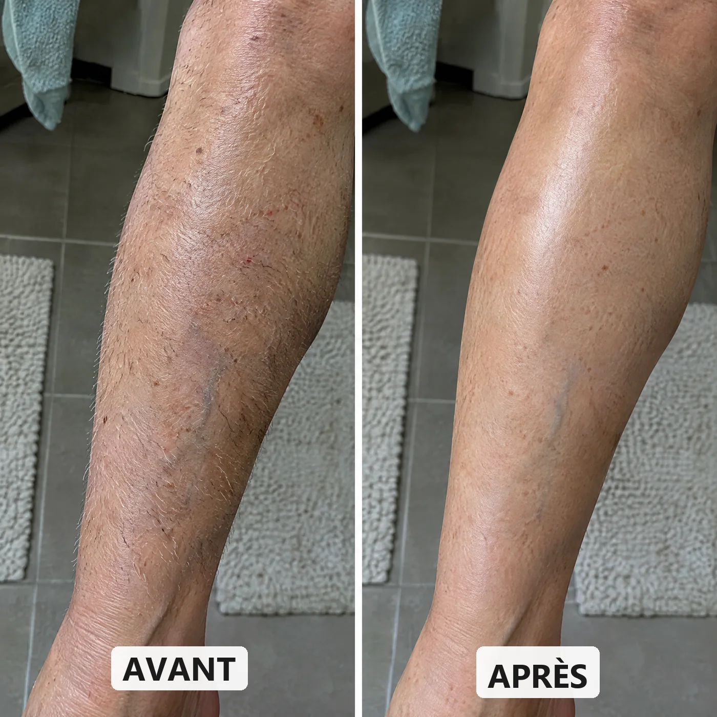 La même jambe avant et après Doucelle : poils gris et blancs visibles à gauche, peau lisse à droite