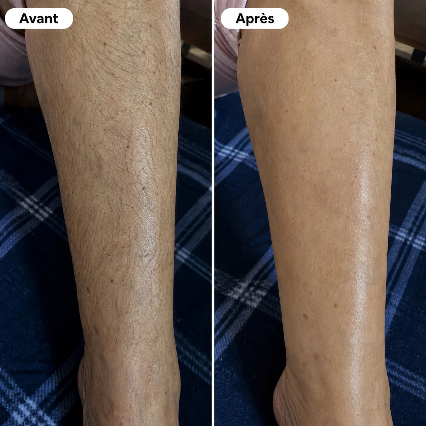 Avant / après sur une jambe
