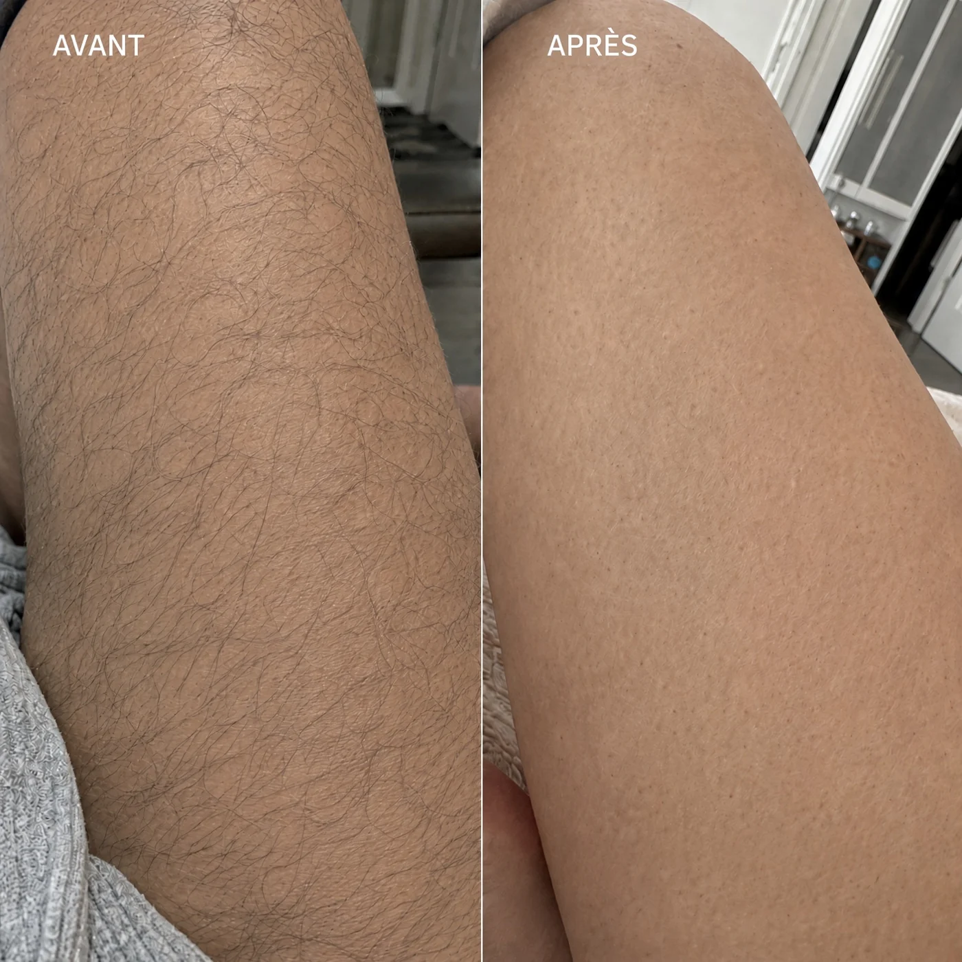 Avant / après sur un bras