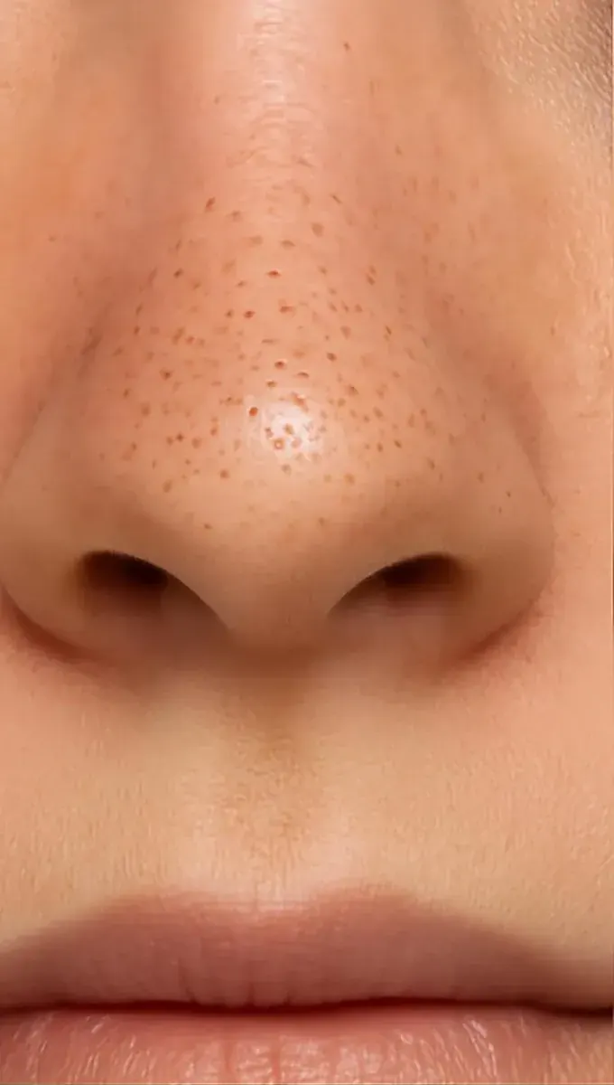 Après — pores nettoyés