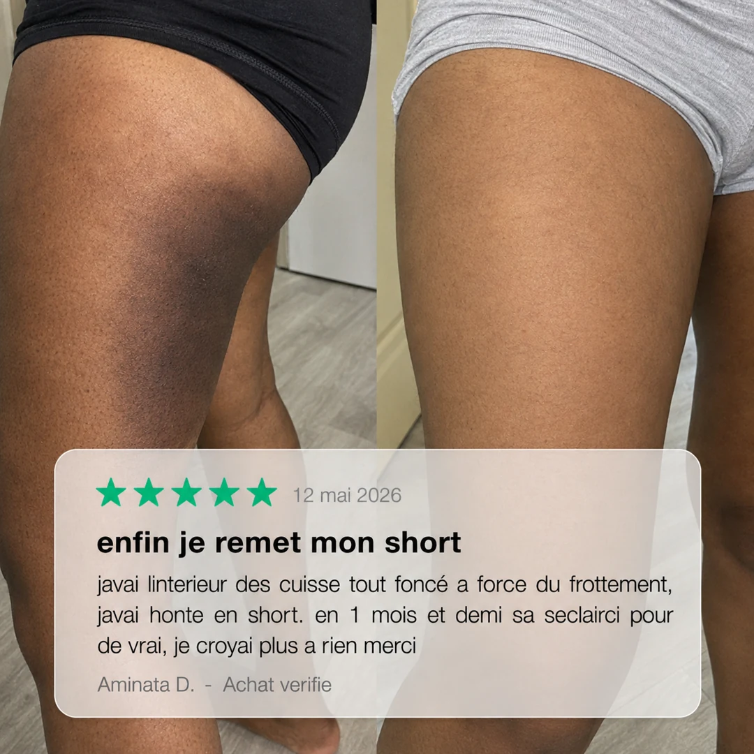 Avis cliente avant après intérieur des cuisses