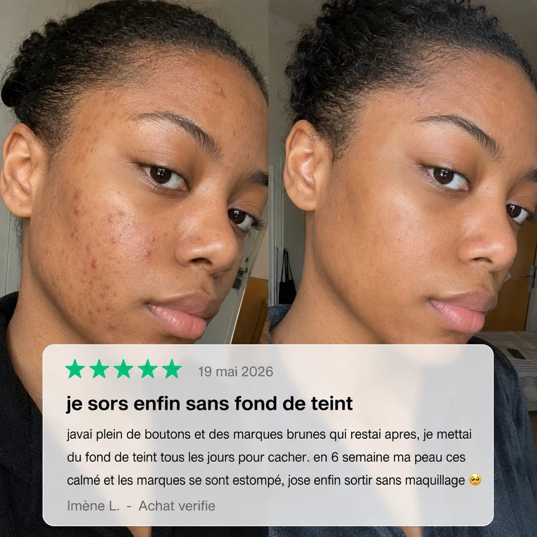 Avis cliente avant après acné visage