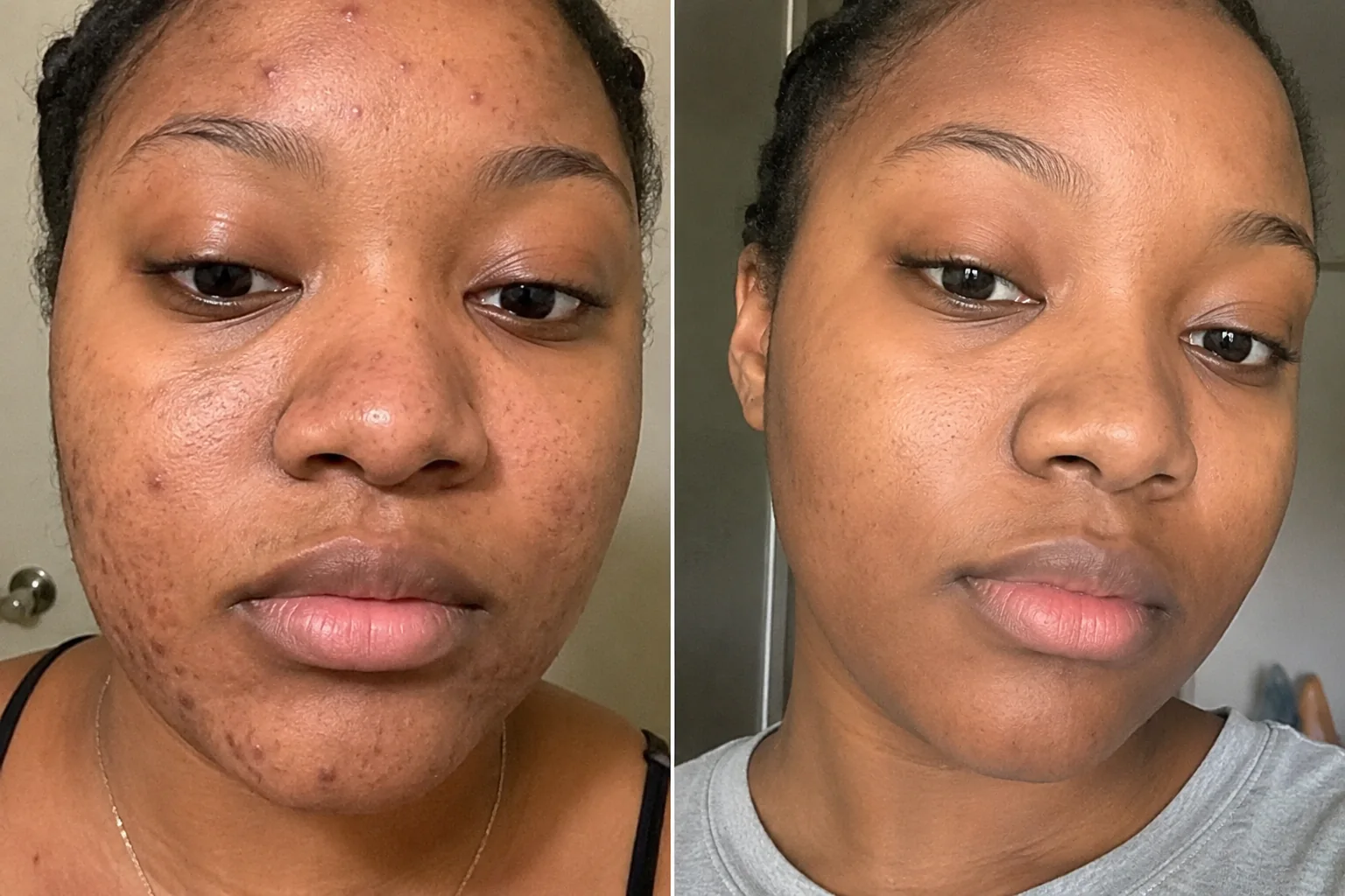 Avant / après visage d'une cliente à peau sensible : boutons et taches foncées estompés