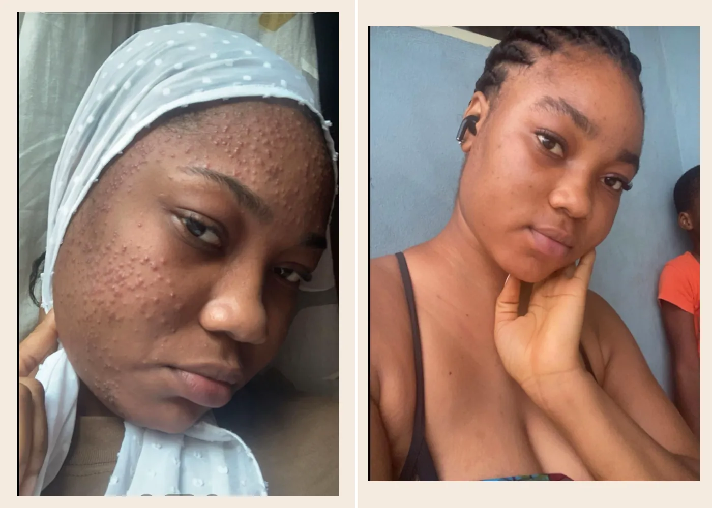 Visage avant / après — peau plus nette et teint plus uniforme