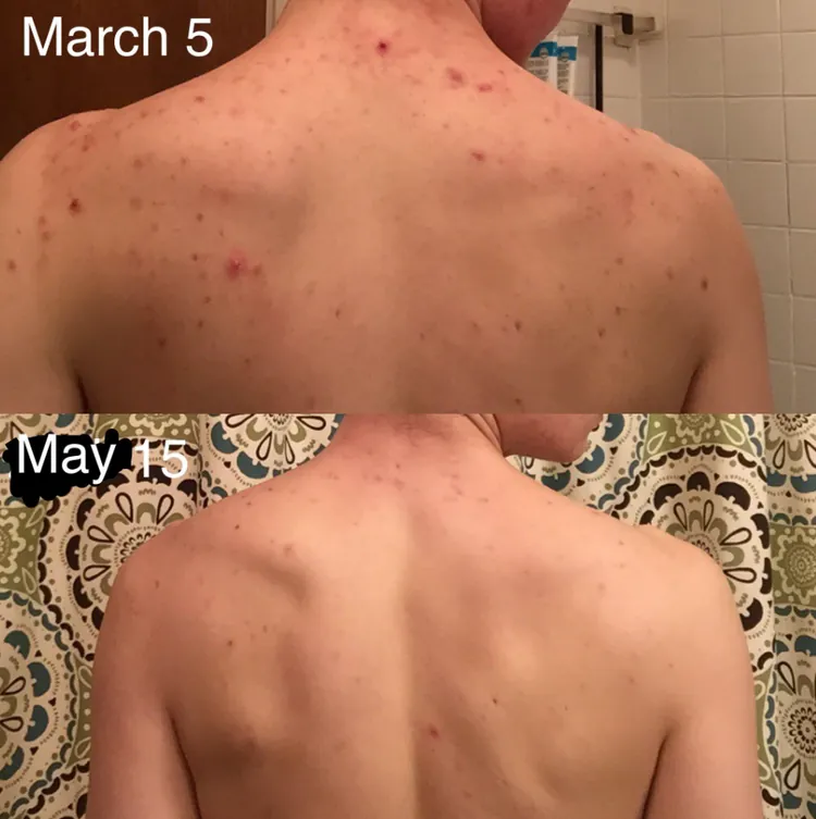 Avant / après dos — avis client