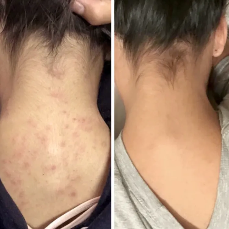 Avant / après nuque — avis client