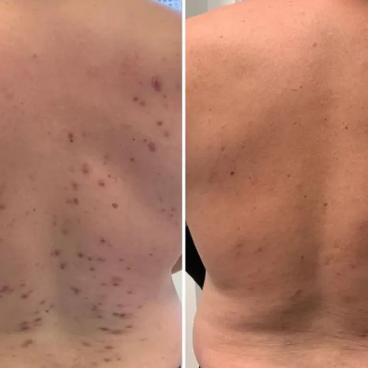 Avant / après dos homme — avis client