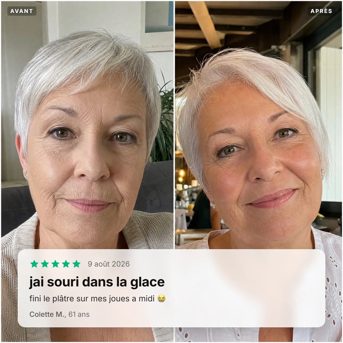 Avant / après de Colette M., 61 ans : j'ai souri dans la glace