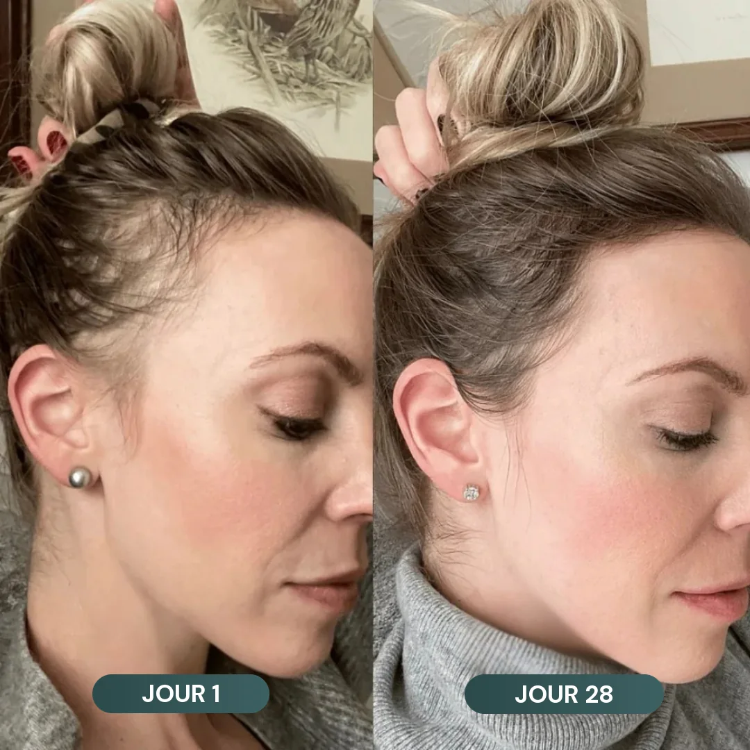 Les tempes d'Inès Z. au jour 1 et au jour 28 : les cheveux repoussent, plus denses