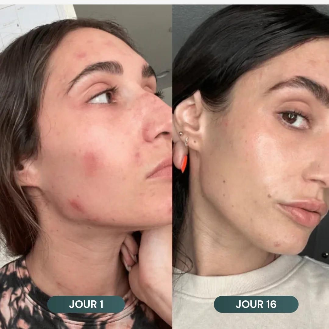 Le visage de Marie L. au jour 1 et au jour 16 : les rougeurs et les boutons ont disparu