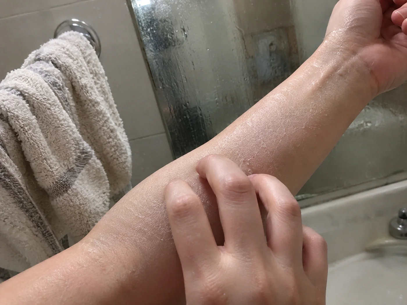 Un avant-bras à la peau sèche qui tiraille, juste après la douche
