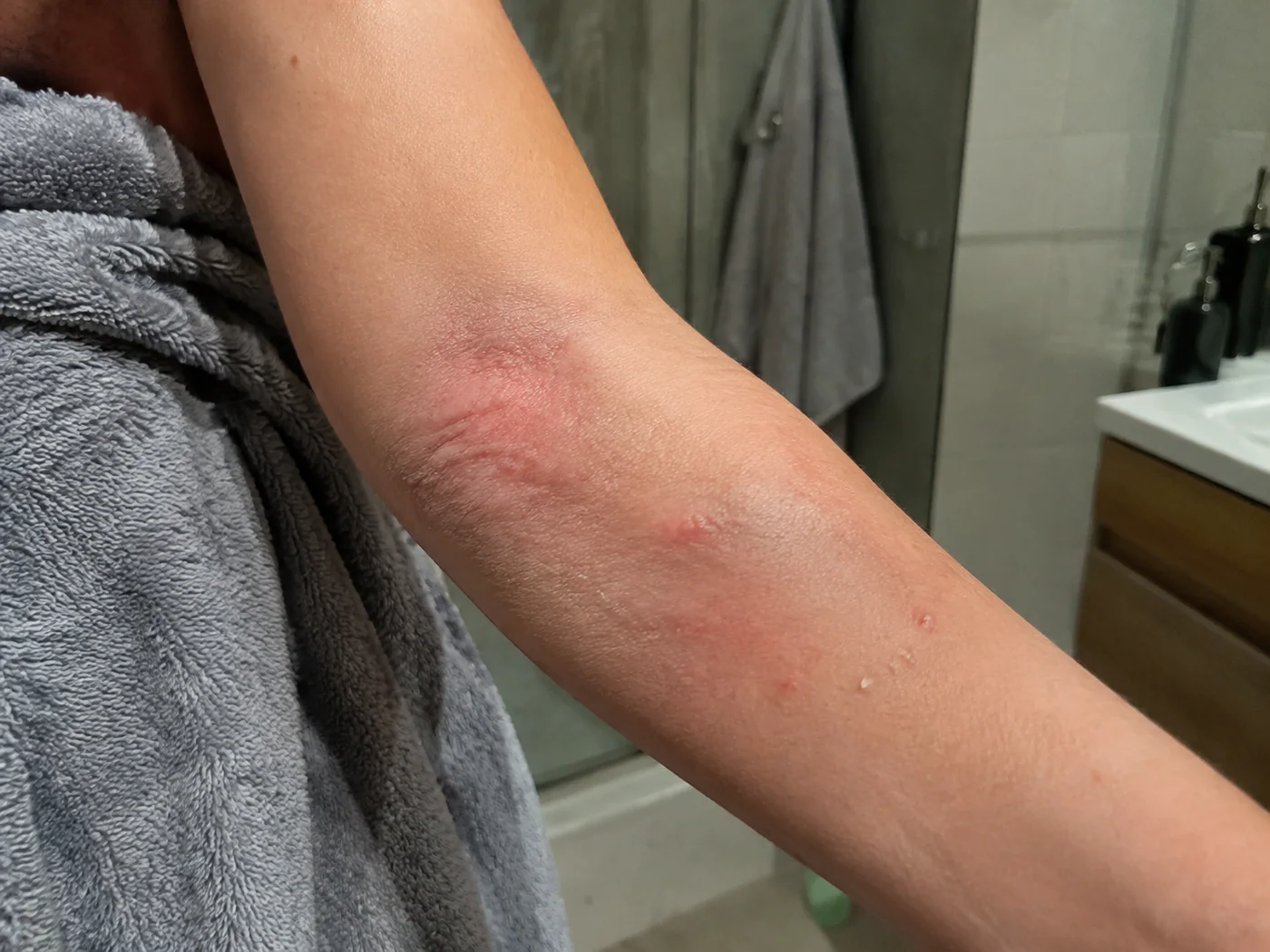 Une peau sèche et rougie après une douche chaude